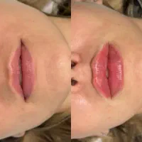 ژل بوتاکس مزو|خدمات آرایشگری و زیبایی|صدرا-فارس, فاز ۱|دیوار