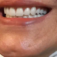 دندانسازی پروتز متحرک دندان مصنوعی دندان ساز