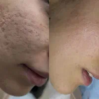 از بین بردن لک و جای جوش فرورفته صورت گچساران|خدمات آرایشگری و زیبایی|دهدشت, |دیوار