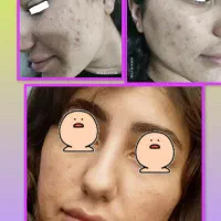 میکرونیدلینگ پوست . خالبرداری ، پیرسینگ، شیدینگ