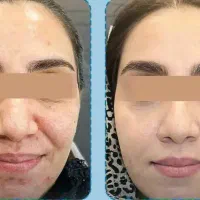 رضایت مشتری پک ضد لک