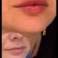 نیازمند مدل ژل / بوتاکس