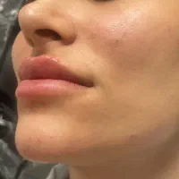 تزریق ژل کات گونه و سیب گونه هزینه مواد۵۵۰