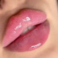 جشنواره تزریق بوتاکس و ژل فیلر چانه گونه زاویه لب|خدمات آرایشگری و زیبایی|فردیس, فردیس|دیوار