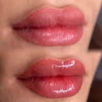 میکروبلیدینگ،شیدینگ،خط چشم،فیبروز