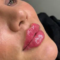 تخفیفات ۵۰ درصدی ژل بوتاکس در مطب دکتر