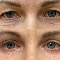 بوتاکس ژل نخ بلفاروپلاستی مزو چربی|خدمات آرایشگری و زیبایی|اصفهان, مولوی|دیوار