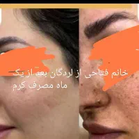کرم معجزه اصل ضد لک و جوش سفید شدن پوست ضمانتی|آرایشی، بهداشتی، درمانی|لردگان, |دیوار