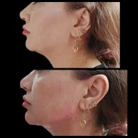 تزریق ژل فیلر بوتاکس مزوژل مزوتراپی مزو مو|خدمات آرایشگری و زیبایی|فولادشهر, C4|دیوار