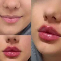 تزریق چربی،ژل،بوتاکس ونخ و مادلینگ تخصصی توسط پزشک|خدمات آرایشگری و زیبایی|کرمانشاه, |دیوار