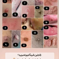 با زگیلات خداحافظی کن