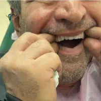 اوردنچر و فول فک با ایمپلنت 108 تومان+اقساط