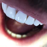 دندانپزشکی دندانسازی پونک سیمون بولیوار کامپوزیت
