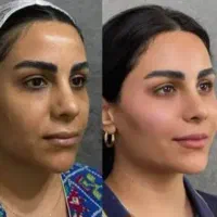 بوتاکس ژل فقط ۱/۱۰۰ فول فیس فقط ۱۱ت
