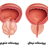 درمان پروستات 100٪
