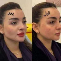 ژل بوتاکس فیلر چشم زاویه فک گونه چانه فشیال بیکینی|خدمات آرایشگری و زیبایی|قم, زنبیل آباد|دیوار