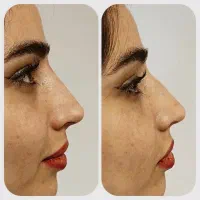 جشنواره ویژه کاشت ابرو ،بوتاکس، فیلر ..|خدمات آرایشگری و زیبایی|بوشهر, |دیوار