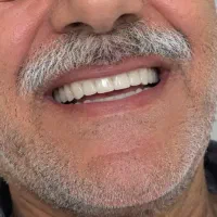 ساخت پروتز دندان(دندان مصنوعی) با ضمانت