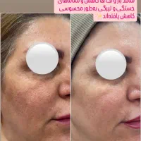 روشن سازی با لیزر پیکوشور و پاک کردن تتو