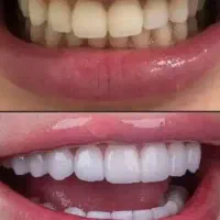 کامپوزیت ونیر و لمینت دندان (جشنواره یلدا)