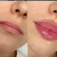 آموزش و تزریق ژل وفیلر و بوتاکس  هایفو