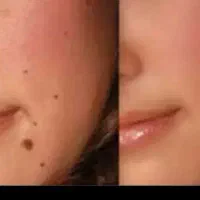 خال پوستی وگوشتی وزیگیل|خدمات زیبایی و سلامت|کرمانشاه, |دیوار