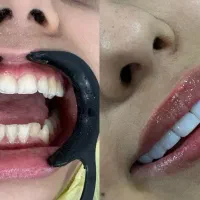کامپوزیت دندان طرح لبخند ، جرمگیری، پالیش، بلیچینگ