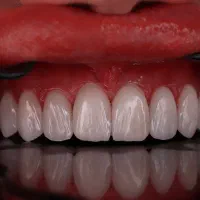 کامپوزیت دندان ۵۰٪ تخفیف اقساط|خدمات زیبایی و سلامت|کرج, عظیمیه|دیوار