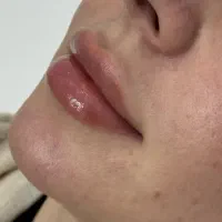تزریق تخصصی ژل و بوتاکس زیر نظر متخصصین مجرب|خدمات آرایشگری و زیبایی|کرمانشاه, |دیوار