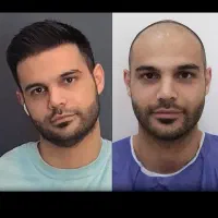 اقساطی کاشت مو تضمینی/کاشت ابرو کاشت|خدمات آرایشگری و زیبایی|تهران, چیذر|دیوار