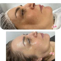 فیشال و نخ کلاژن به جای بوتاکس|خدمات آرایشگری و زیبایی|اصفهان, کوی ولی عصر|دیوار