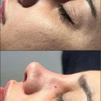 اف عمل زیبایی بینی|خدمات آرایشگری و زیبایی|دهدشت, |دیوار