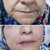 لیزر بوتاکس ژل خالبرداری|خدمات آرایشگری و زیبایی|سیرجان, |دیوار