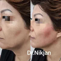 فیلر/بوتاکس/لب روسی/جوانساز/مزوژل مطب دکتر نیک جان|خدمات آرایشگری و زیبایی|رشت, گلسار|دیوار