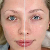 مدل فوری فیبروز ابرو (ظرفیت محدود)