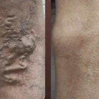 درمان تخصصی واریس