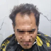 جشنواره کاشت مو|خدمات آرایشگری و زیبایی|شیراز, قصرالدشت|دیوار
