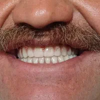 دندان مصنوعی با ۵۰٪تخفیف ساخت دندان مصنوعی متحرک