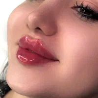 تزریق ژل لب مدل روسی فیلربادی مزوژل آنزیم