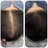 کلینیک تخصصی پوست و مولیزر اسکالپ فیشال بوتاکس ژل