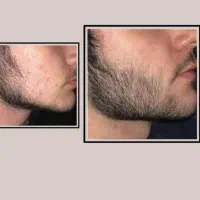 راه حل رفع کم پشتی ریش