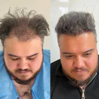 کاشت مو و ابرو.با شرایط ویژه پنچ تومن|خدمات آرایشگری و زیبایی|تبریز, |دیوار