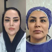 جراحی افتادگی پلک فقط ۷.۹۹۰میلیون