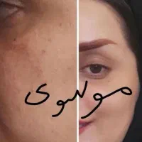 روشن کننده وضدلک درمانی بدون بازگشت تضمینی|آرایشی، بهداشتی، درمانی|یاسوج, |دیوار