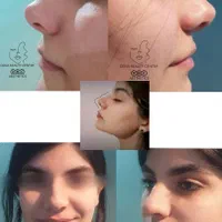 فیلرصورت بوتاکس کربن هایفو لیزرمو ریموتتو جوانسازی|خدمات آرایشگری و زیبایی|یاسوج, |دیوار