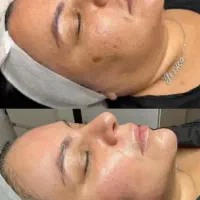 پوستی شفاف ،جوان و  لیفت شده  با پلاژن تراپی