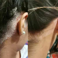 درمان تضمینی پیسی و پسوریازیس|خدمات آرایشگری و زیبایی|مشگین شهر, |دیوار