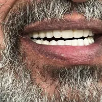 دندانسازی  دندان مصنوعی  پروتز دندان|خدمات آرایشگری و زیبایی|قم, کلهری|دیوار