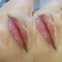 ژل،بوتاکس،مزو،چال لپ،فیلر|خدمات آرایشگری و زیبایی|قم, عمار یاسر|دیوار