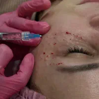 لیزر تاتو  ابرو. و بدن  لیزر مو  فیلر لب بوتاکس